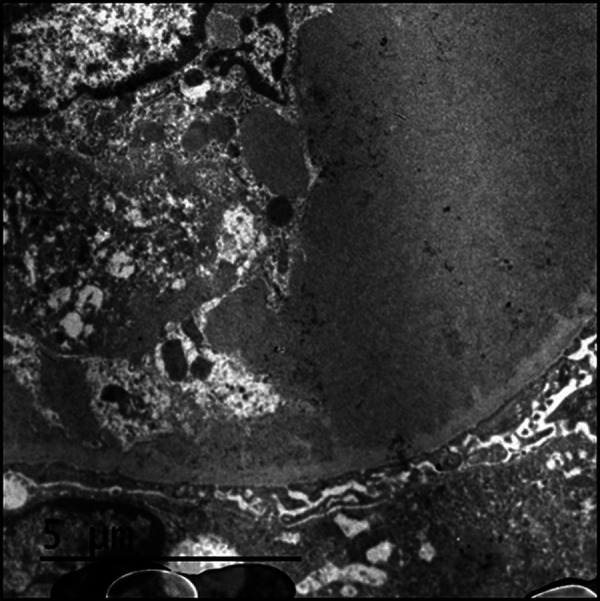 Monoclonal gammopathy of renal significance: An atypical presentation of Waldenström's disease.