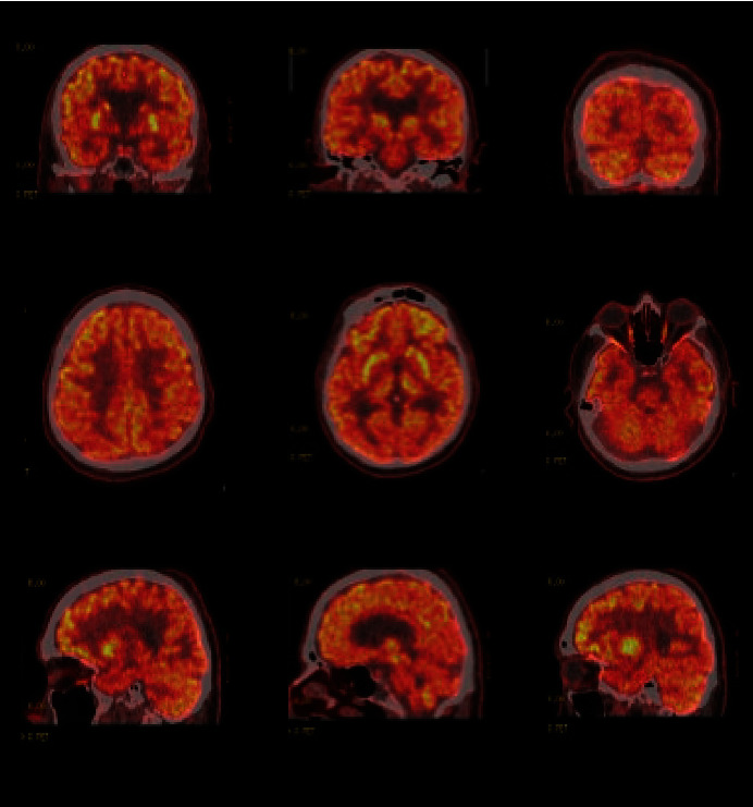 A Case of Posterior Cortical Atrophy Presenting with Mood and Psychotic Symptoms.