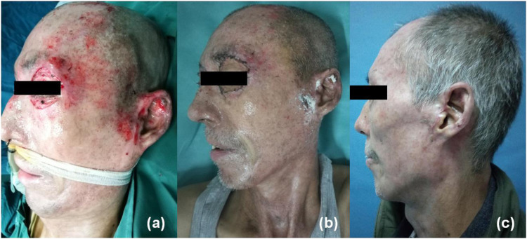 Autologous nanofat harvested from donor site of full-thickness skin or skin flap grafting for the treatment of early postburn scarring: a case series.