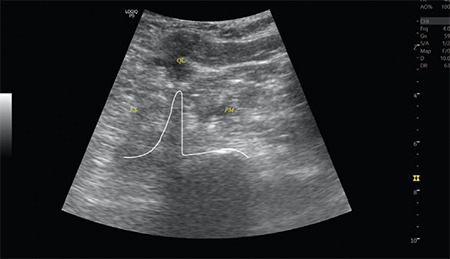 Combined Lumbar-Sacral Plexus Block in Facioscapulohumeral Muscular Dystrophy for Hip Fracture Surgery: A Case Report.
