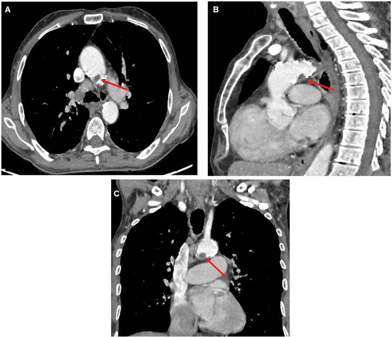 Floating Thrombus in the Aortic Arch: Rare Images.
