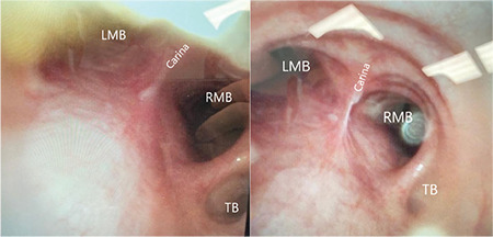 Use of an Endobronchial Blocker in a Patient with Tracheobronchial Anomaly for Minimally Invasive Cardiac Surgery: A Case Report.