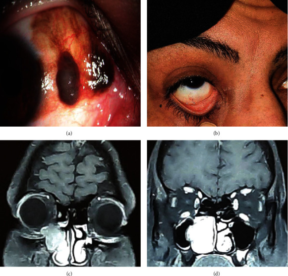 Lacrimal Drainage System and Nasal Cavity Melanoma after Complete Treatment of Conjunctival Melanoma.