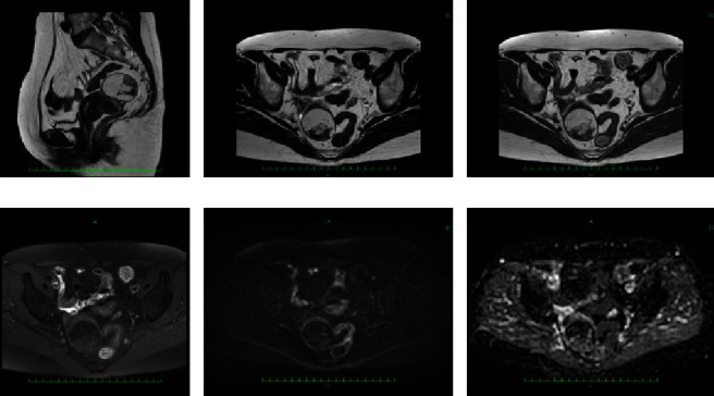 Well-Differentiated Liposarcoma That Increased in Size after Menopause: A Case Report and a Review of the Literature.