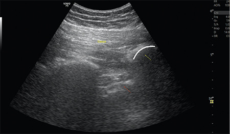 Combined Lumbar-Sacral Plexus Block in Facioscapulohumeral Muscular Dystrophy for Hip Fracture Surgery: A Case Report.