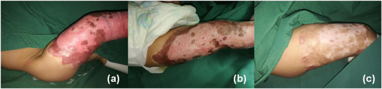 Autologous nanofat harvested from donor site of full-thickness skin or skin flap grafting for the treatment of early postburn scarring: a case series.