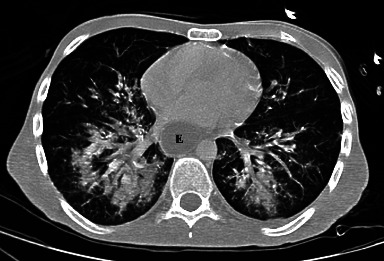 Deadly Aspiration Pneumonia Secondary to Superior Mesenteric Artery Syndrome.