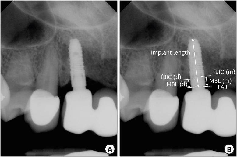 Clinical evaluation of 3.0-mm narrow-diameter implants: a retrospective study with up to 5 years of observation.