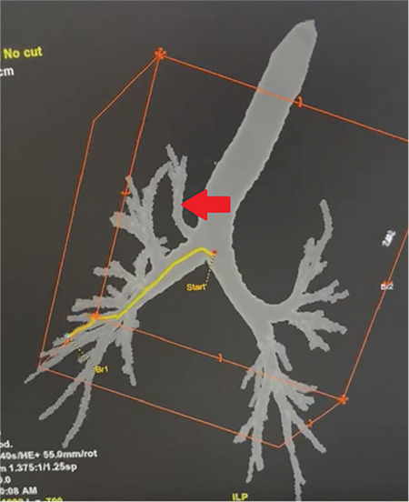 Use of an Endobronchial Blocker in a Patient with Tracheobronchial Anomaly for Minimally Invasive Cardiac Surgery: A Case Report.