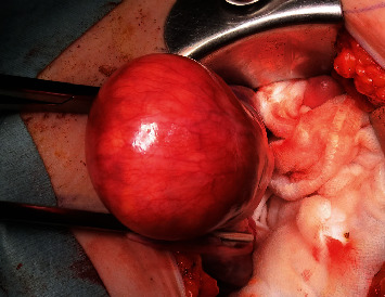 Well-Differentiated Liposarcoma That Increased in Size after Menopause: A Case Report and a Review of the Literature.