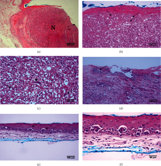 Lacrimal Drainage System and Nasal Cavity Melanoma after Complete Treatment of Conjunctival Melanoma.