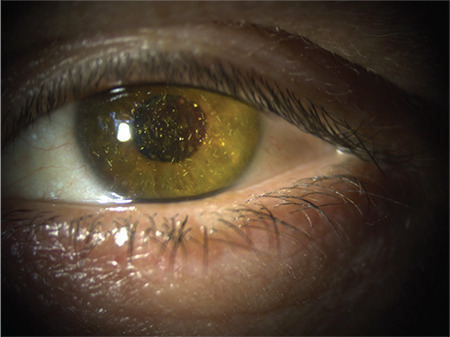 A Rare Association: Neovascular Glaucoma Accompanying Anterior Chamber Synchysis Scintillans