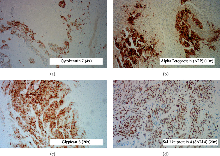 Primary Yolk Sac Tumor of the Liver: A Rare Cause of Bile Duct Obstruction.
