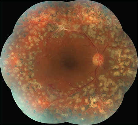 A Rare Association: Neovascular Glaucoma Accompanying Anterior Chamber Synchysis Scintillans