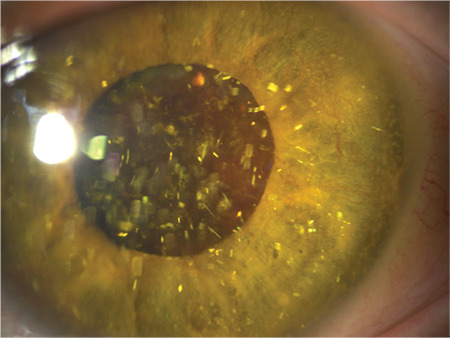 A Rare Association: Neovascular Glaucoma Accompanying Anterior Chamber Synchysis Scintillans