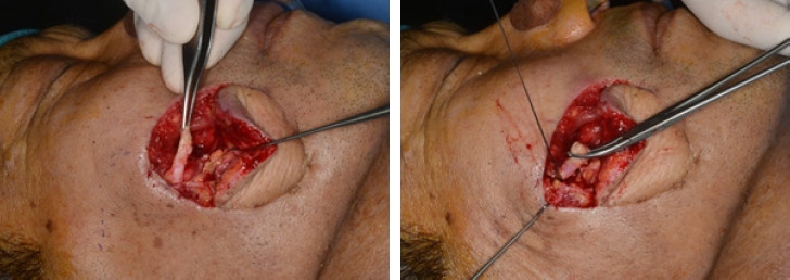 Transdermal scopolamine for the treatment of recurrent parotid sialocele: a case report.
