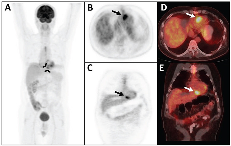 <sup>18</sup>F-FDG PET/CT Imaging for Treatment Response Assessment of Cardiac Primitive Neuroectodermal Tumor.