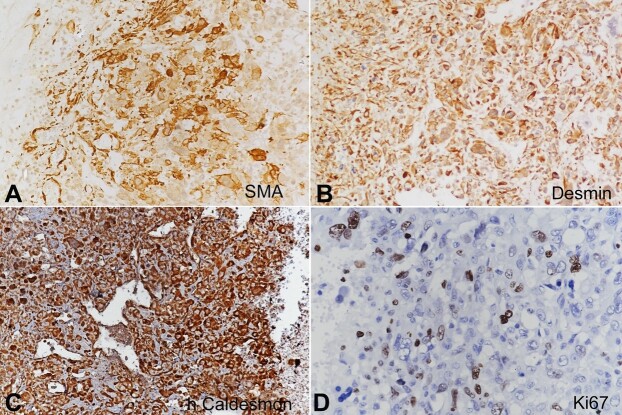 Primary leiomyosarcoma with osteosarcomatous differentiation of the breast.