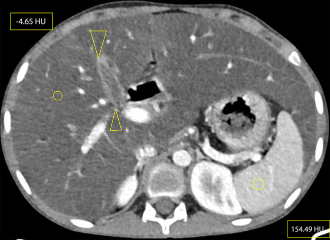 Cystic Fibrosis in an Adolescent: A "Miranda Warning" Against Blaming TB-A Case-Based Scholarly Update.