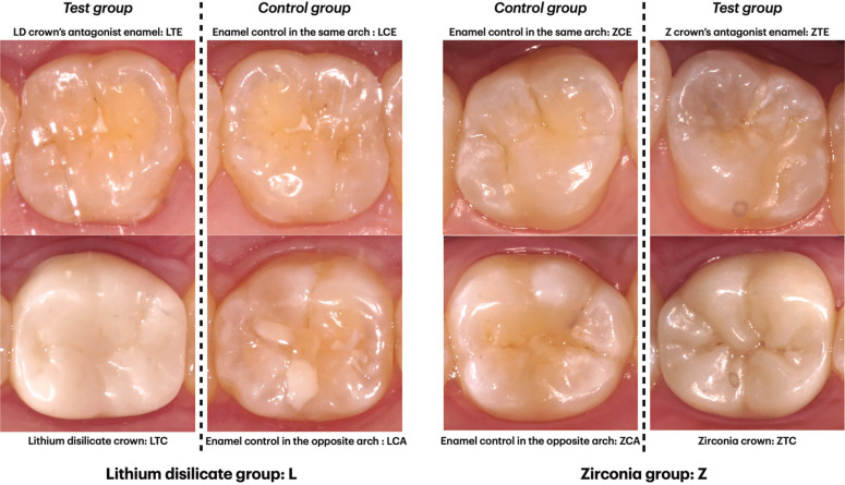3D quantitative analysis and SEM qualitative analysis of natural antagonist enamel opposing CAD-CAM monolithic zirconia or lithium disilicate tooth-supported crowns versus enamel opposing natural enamel.