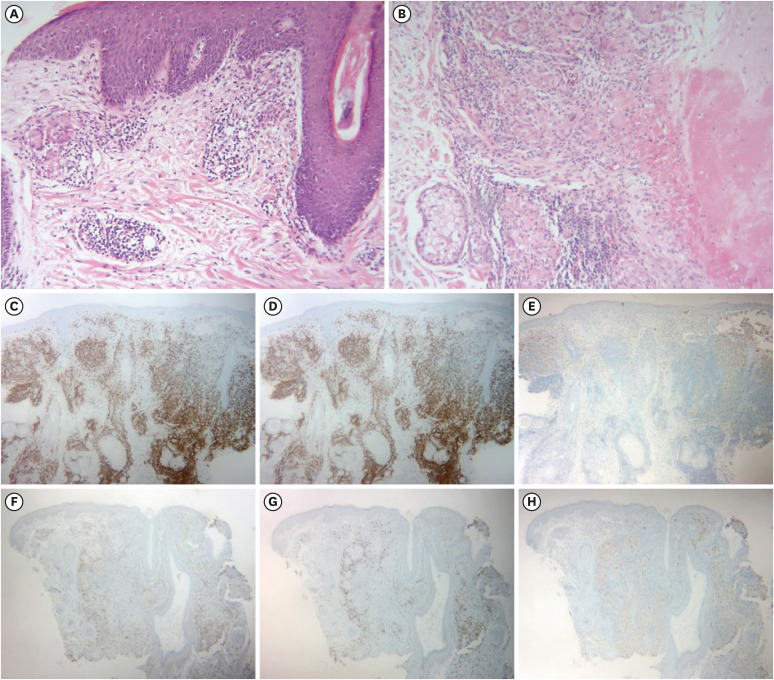 A Comparative Study on Clinico-Histopathological Features of Granulomatous Rosacea and Lupus Miliaris Disseminatus Faciei.