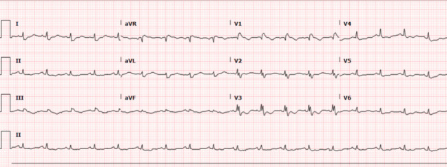 Use of Ultrasound-Assisted, Catheter-Directed Thrombolysis in a Patient With High-Risk Pulmonary Embolism.