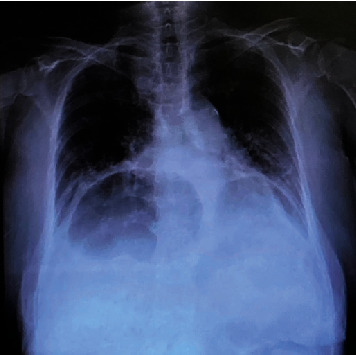 Small Bowel Obstruction Caused by Type IV Hiatal Hernia.