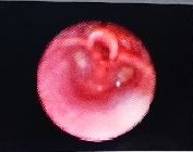 Infantile Subglottic Hemangioma: A Case ReportInfantile Subglottic Hemangioma: A Case Report.