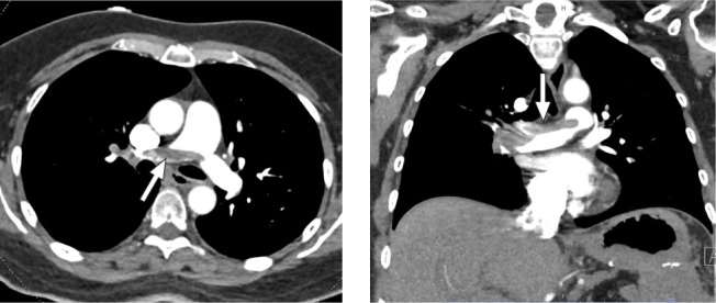 Use of Ultrasound-Assisted, Catheter-Directed Thrombolysis in a Patient With High-Risk Pulmonary Embolism.
