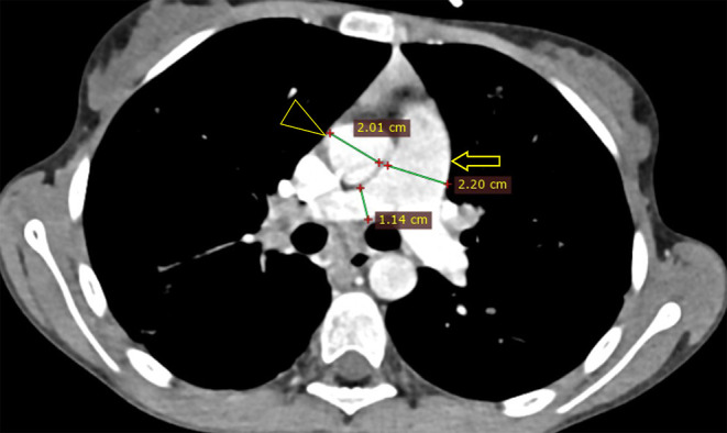 Cystic Fibrosis in an Adolescent: A "Miranda Warning" Against Blaming TB-A Case-Based Scholarly Update.