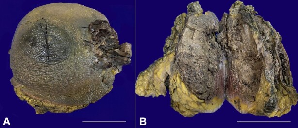 Primary leiomyosarcoma with osteosarcomatous differentiation of the breast.