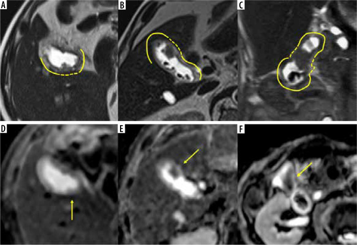 Differentiating gallbladder cancer from polyps using non-enhanced magnetic resonance imaging.