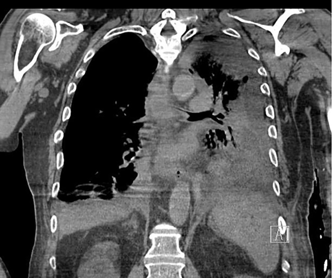 Boerhaave's Syndrome Presenting in the Setting of Third-Degree Heart Block.