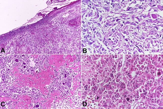 Primary leiomyosarcoma with osteosarcomatous differentiation of the breast.