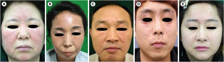 A Comparative Study on Clinico-Histopathological Features of Granulomatous Rosacea and Lupus Miliaris Disseminatus Faciei.