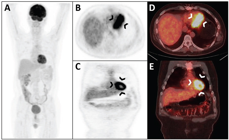 <sup>18</sup>F-FDG PET/CT Imaging for Treatment Response Assessment of Cardiac Primitive Neuroectodermal Tumor.