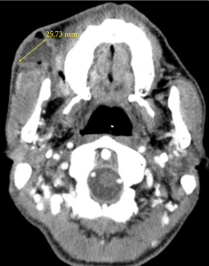 Transdermal scopolamine for the treatment of recurrent parotid sialocele: a case report.