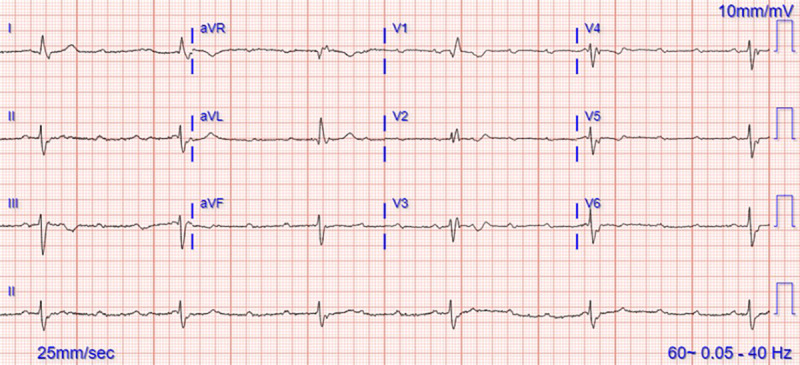 Boerhaave's Syndrome Presenting in the Setting of Third-Degree Heart Block.