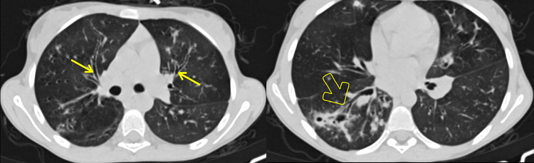 Cystic Fibrosis in an Adolescent: A "Miranda Warning" Against Blaming TB-A Case-Based Scholarly Update.