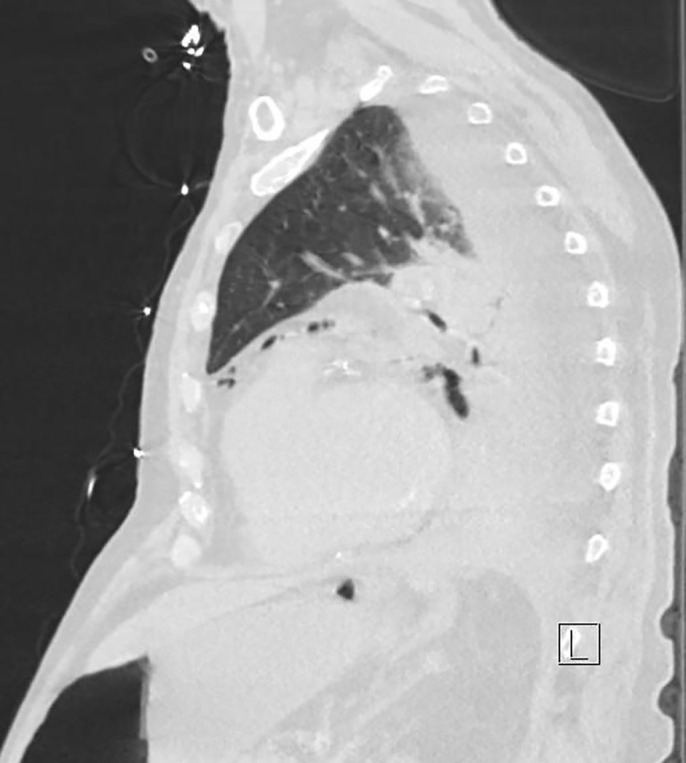 Boerhaave's Syndrome Presenting in the Setting of Third-Degree Heart Block.