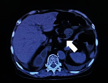 Small Bowel Obstruction Caused by Type IV Hiatal Hernia.