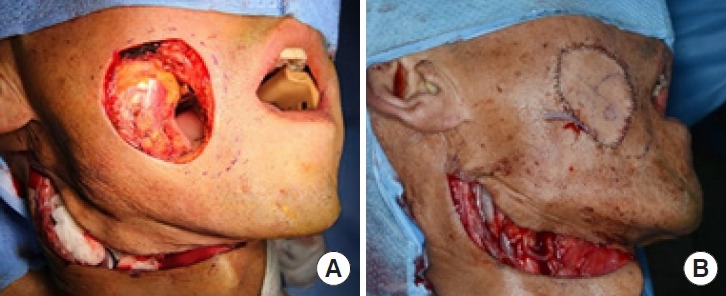 Transdermal scopolamine for the treatment of recurrent parotid sialocele: a case report.