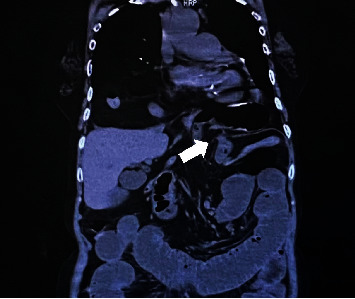 Small Bowel Obstruction Caused by Type IV Hiatal Hernia.