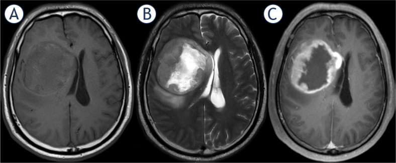 Looking through the imaging perspective: the importance of imaging necrosis in glioma diagnosis and prognostic prediction - single centre experience.