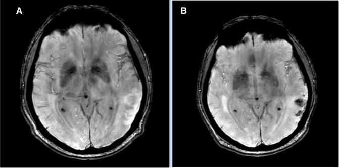 Early anticoagulation in patients with stroke and atrial fibrillation is associated with fewer ischaemic lesions at 1 month: the ATTUNE study.