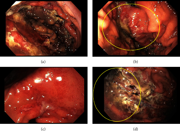 Upper Gastrointestinal Bleeding Secondary to Sodium Polystyrene Sulfonate Use: A Rare Adverse Effect of Commonly Prescribed Treatment.