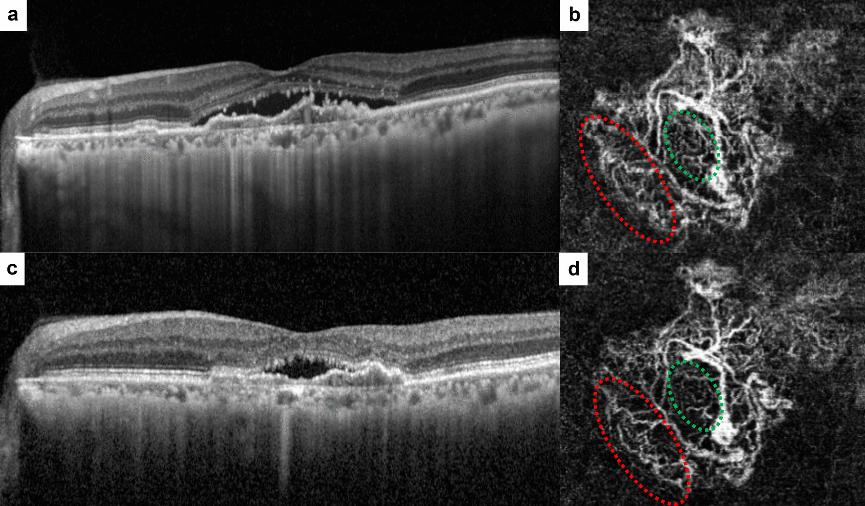 Features of optical coherence tomography angiography in age-related macular degeneration with residual fluid after three loading doses of aflibercept.