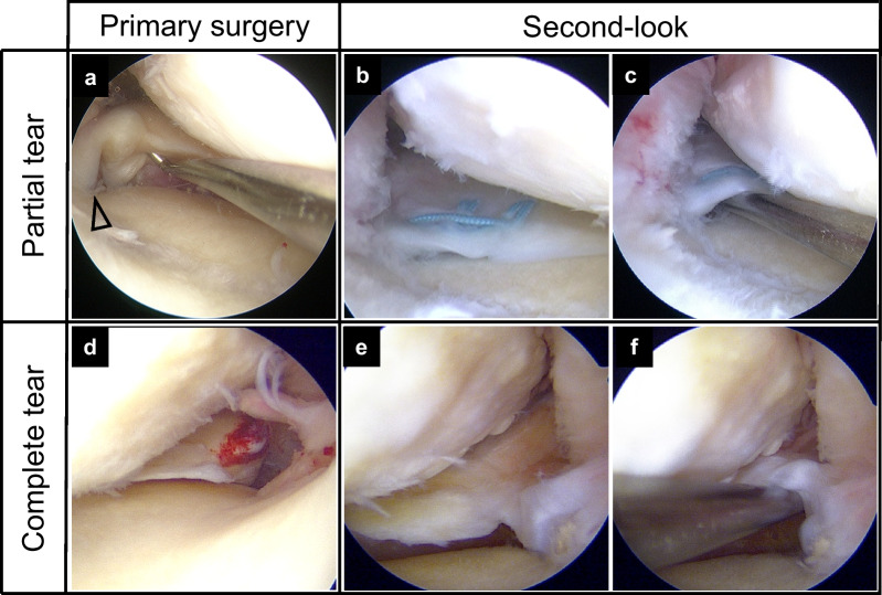 Superior outcomes of pullout repairs for medial meniscus posterior root tears in partial tear compared to complete radial tear.