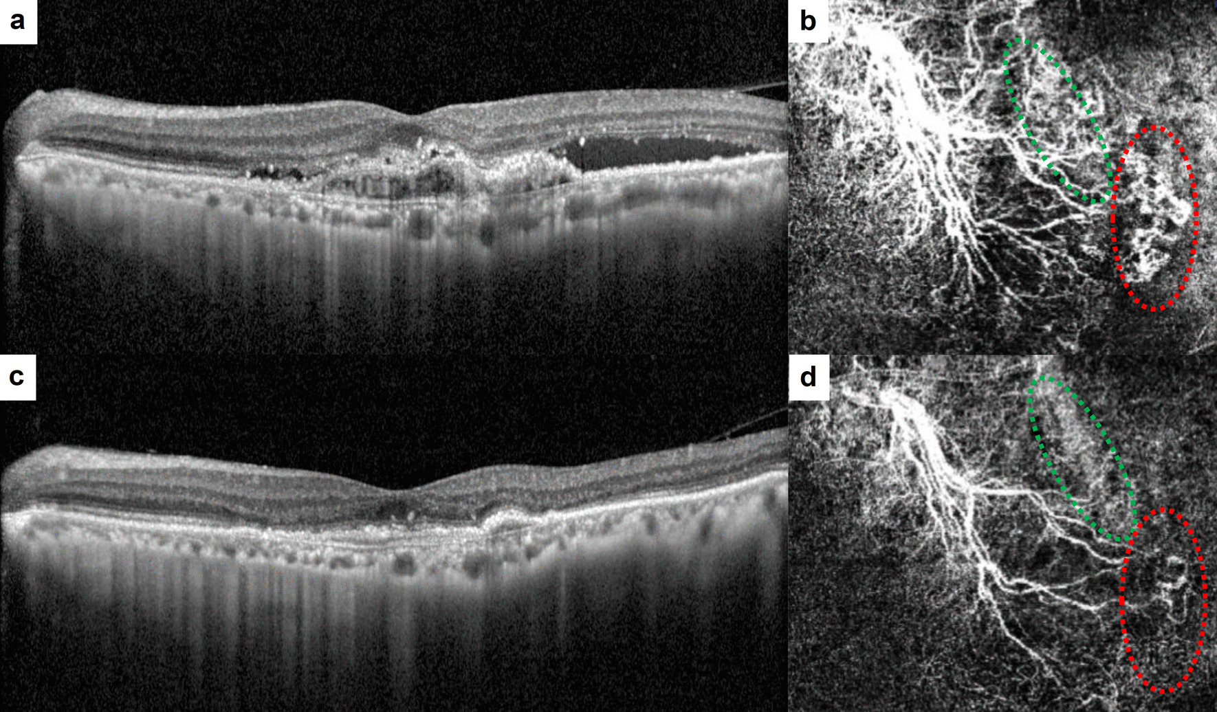 Features of optical coherence tomography angiography in age-related macular degeneration with residual fluid after three loading doses of aflibercept.