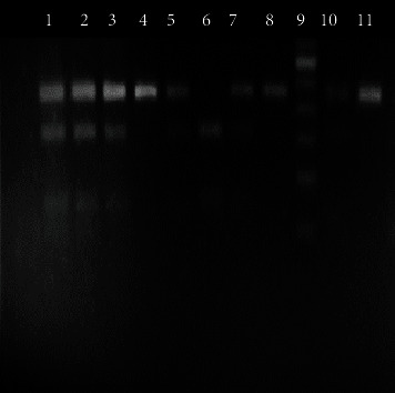 Association of Cytokine IL-17, IL-4, IL-6, and IL-12 Gene Polymorphisms in Rheumatoid Arthritis Patients in a Tertiary Care Hospital in Bangladesh.